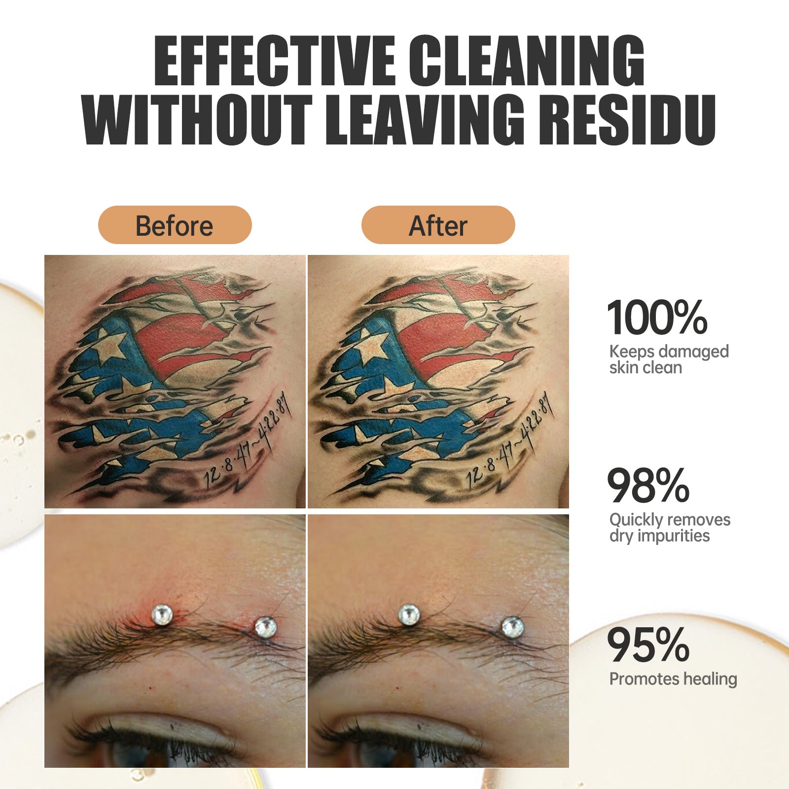 Laser Tattoo Removal – Carolinas Dermatology Group